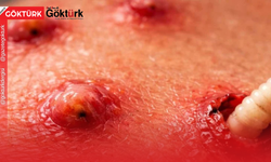 Sivilce Sandığı Şişliğin Altından Canlı Parazit Çıktı