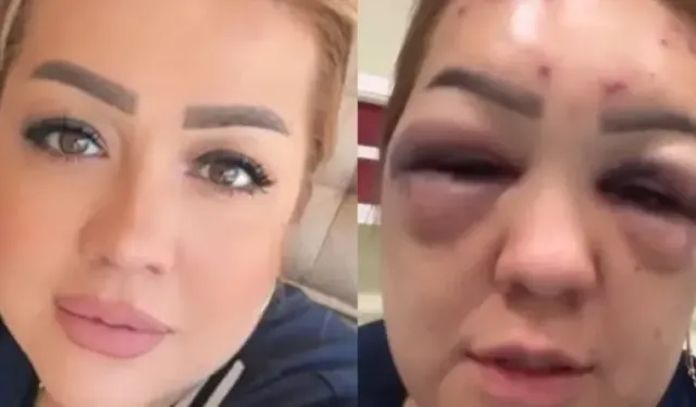 Botoks bu hale getirdi: Yüzü şişti tanınmayacak hale geldi