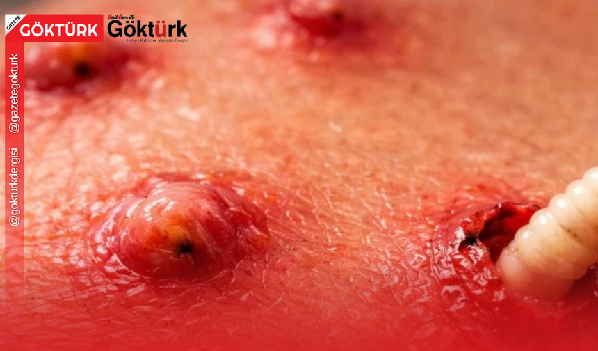 Sivilce Sandığı Şişliğin Altından Canlı Parazit Çıktı